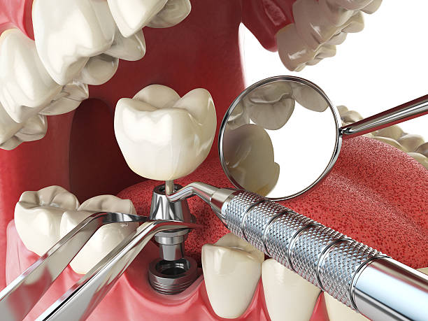 Best Emergency Dental Care for Broken or Chipped Teeth in Longview Heights, WA